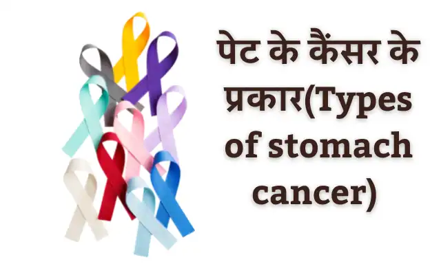 Stomach Cancer: पेट का कैंसर क्या है जानिए इसके प्रकार, कारण, लक्षण एवं इलाज के तरीके हिंदी में| What is stomach cancer Know its types, causes, symptoms and treatments in Hindi