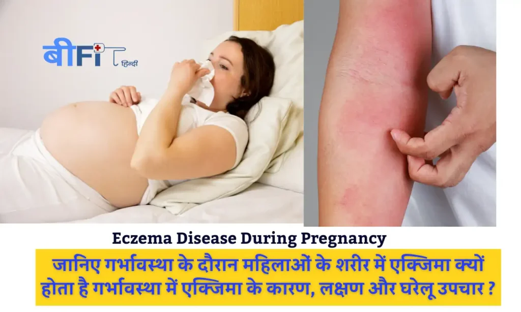 Eczema Disease During Pregnancy : जानिए गर्भावस्था के दौरान महिलाओं के शरीर में एक्जिमा क्यों होता है गर्भावस्था में एक्जिमा के कारण, लक्षण और घरेलू उपचार ?
