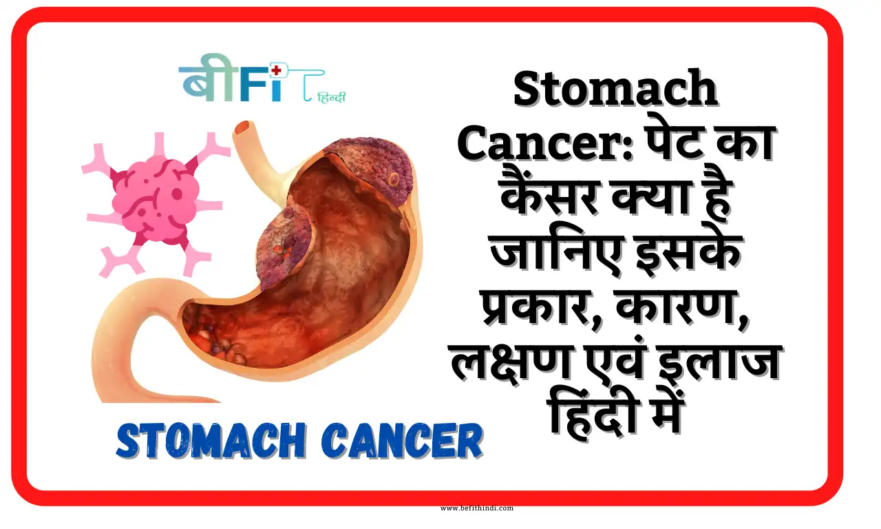 Stomach Cancer: पेट का कैंसर क्या है जानिए इसके प्रकार, कारण, लक्षण एवं इलाज के तरीके हिंदी में| What is stomach cancer Know its types, causes, symptoms and treatments in Hindi